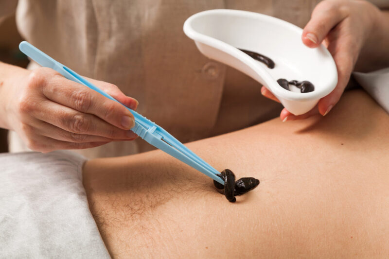 Patient bei Blutegeltherapie in Berlin